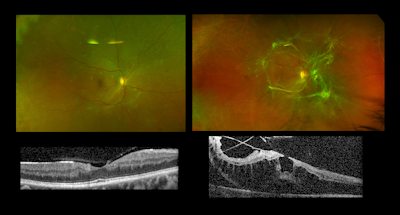 Keeping Up With Advances in Retinal Disease Therapeutics